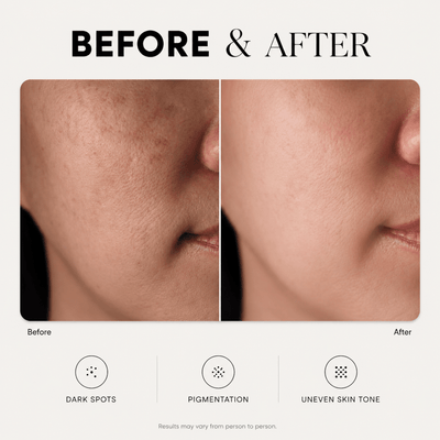 Dark Spot Corrector - LYOVA